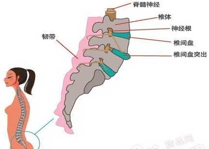 腰椎间盘突出症